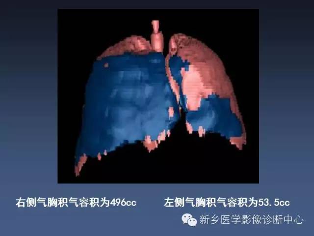 多层螺旋CT（MDCT）在胸部外伤诊断中的应用