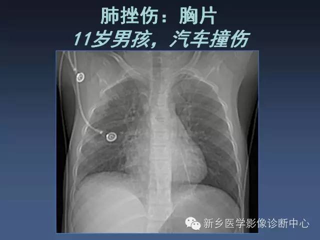 多层螺旋CT（MDCT）在胸部外伤诊断中的应用