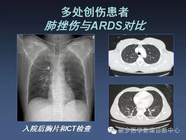 多层螺旋CT（MDCT）在胸部外伤诊断中的应用