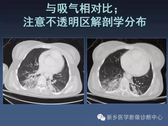 多层螺旋CT（MDCT）在胸部外伤诊断中的应用