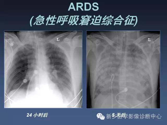 多层螺旋CT（MDCT）在胸部外伤诊断中的应用