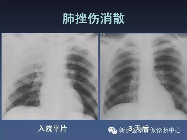 多层螺旋CT（MDCT）在胸部外伤诊断中的应用
