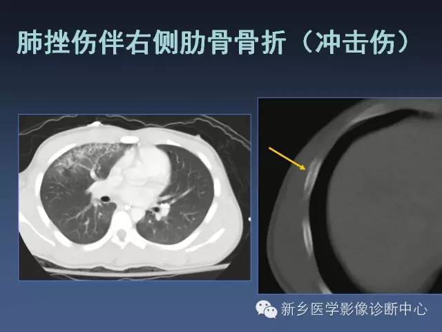 多层螺旋CT（MDCT）在胸部外伤诊断中的应用