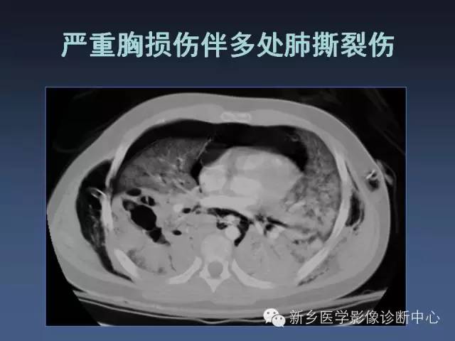 多层螺旋CT（MDCT）在胸部外伤诊断中的应用