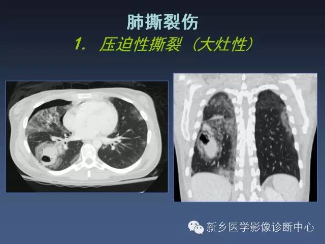 多层螺旋CT（MDCT）在胸部外伤诊断中的应用
