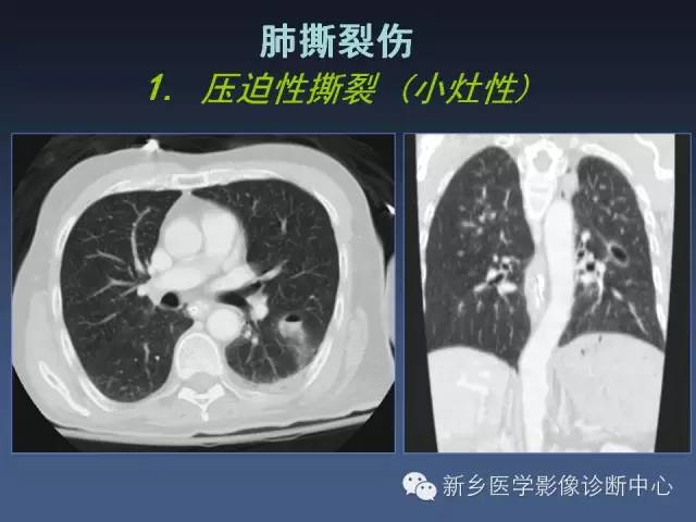 多层螺旋CT（MDCT）在胸部外伤诊断中的应用