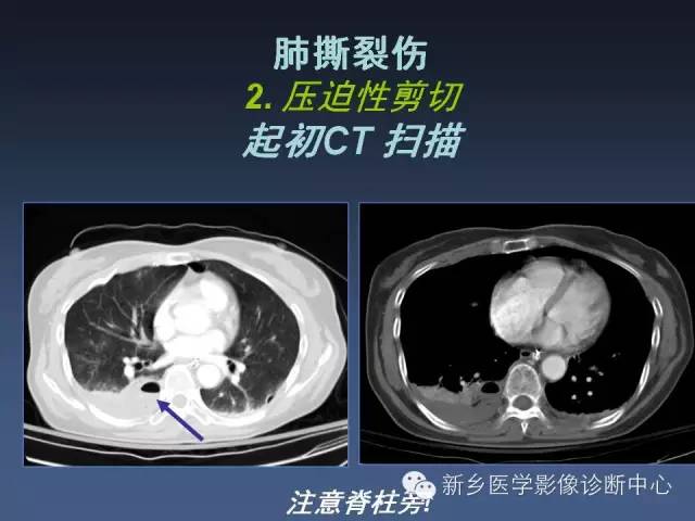 多层螺旋CT（MDCT）在胸部外伤诊断中的应用
