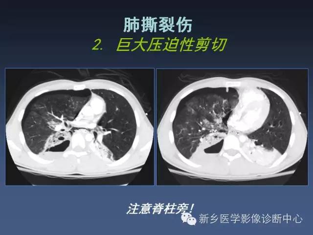 多层螺旋CT（MDCT）在胸部外伤诊断中的应用