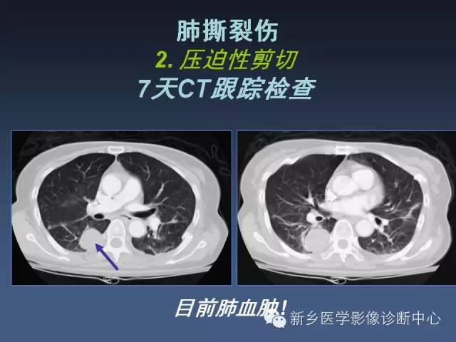 多层螺旋CT（MDCT）在胸部外伤诊断中的应用