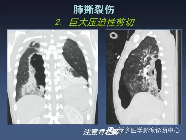 多层螺旋CT（MDCT）在胸部外伤诊断中的应用