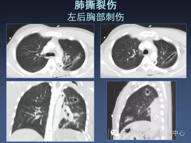 多层螺旋CT（MDCT）在胸部外伤诊断中的应用