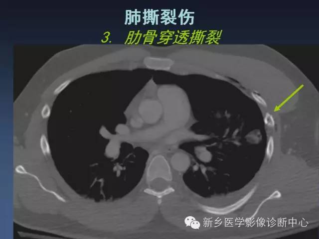 多层螺旋CT（MDCT）在胸部外伤诊断中的应用