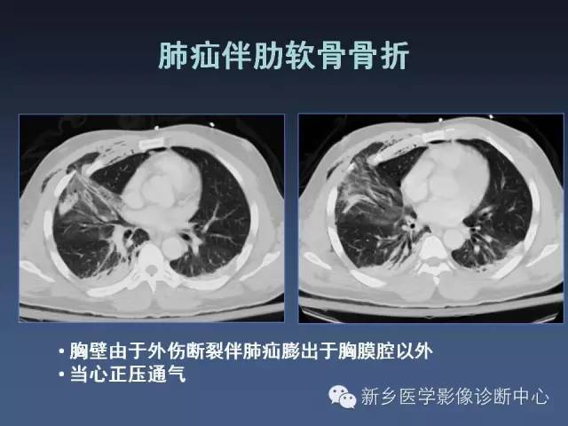 多层螺旋CT（MDCT）在胸部外伤诊断中的应用