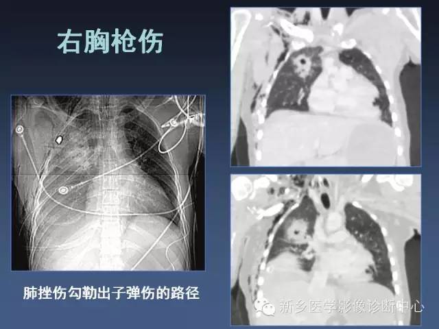 多层螺旋CT（MDCT）在胸部外伤诊断中的应用