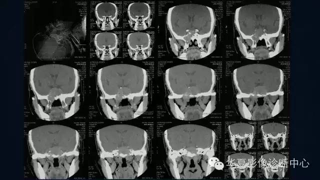 【病例】蝶窦甲状腺转移瘤1例CT MR影像表现