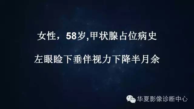 【病例】蝶窦甲状腺转移瘤1例CT MR影像表现