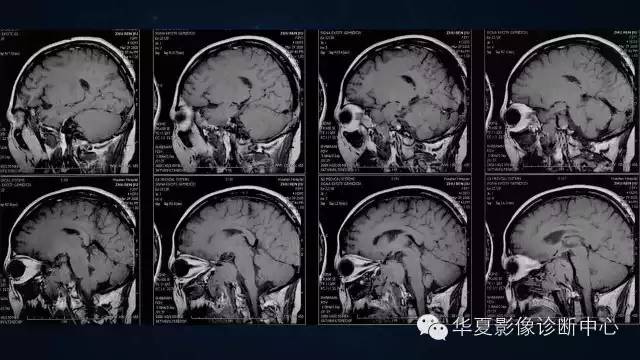 【病例】蝶窦甲状腺转移瘤1例CT MR影像表现