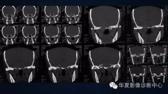 【病例】蝶窦甲状腺转移瘤1例CT MR影像表现