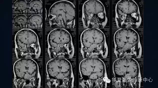 【病例】蝶窦甲状腺转移瘤1例CT MR影像表现