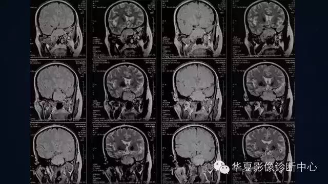 【病例】蝶窦甲状腺转移瘤1例CT MR影像表现