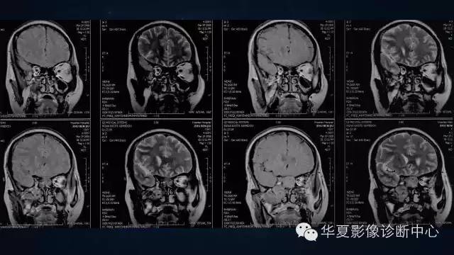 【病例】蝶窦甲状腺转移瘤1例CT MR影像表现
