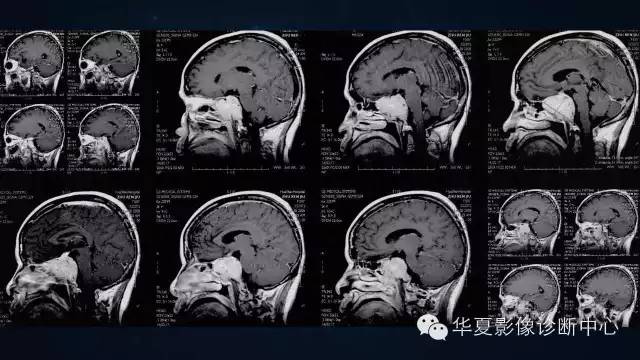 【病例】蝶窦甲状腺转移瘤1例CT MR影像表现