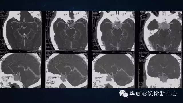 【病例】蝶窦甲状腺转移瘤1例CT MR影像表现