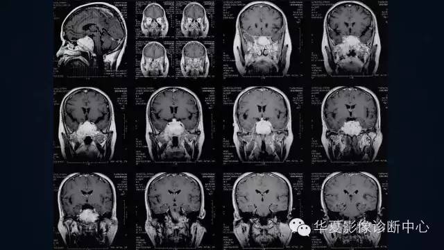 【病例】蝶窦甲状腺转移瘤1例CT MR影像表现