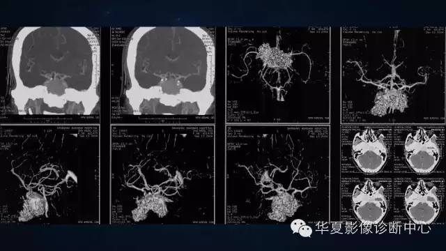 【病例】蝶窦甲状腺转移瘤1例CT MR影像表现