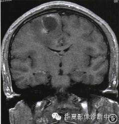 【病例】乳头状胶质神经元肿瘤一例影像表现
