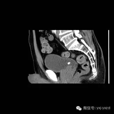 【病例】膀胱癌肉瘤1例CT影像表现
