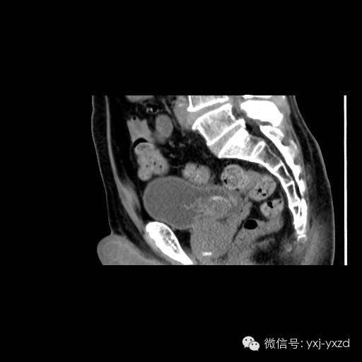 【病例】膀胱癌肉瘤1例CT影像表现 【病例】膀胱癌肉瘤1例CT影像表现