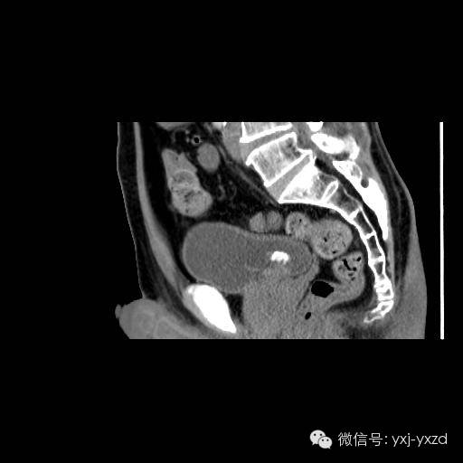 【病例】膀胱癌肉瘤1例CT影像表现 【病例】膀胱癌肉瘤1例CT影像表现