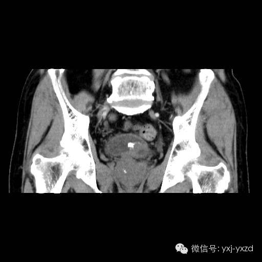 【病例】膀胱癌肉瘤1例CT影像表现 【病例】膀胱癌肉瘤1例CT影像表现