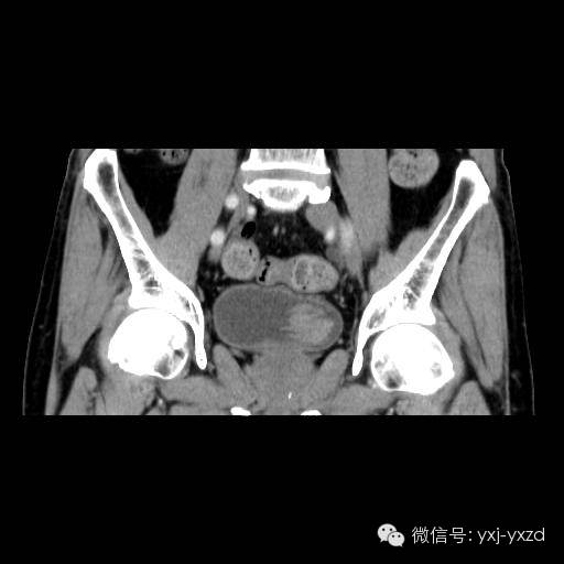 【病例】膀胱癌肉瘤1例CT影像表现 【病例】膀胱癌肉瘤1例CT影像表现