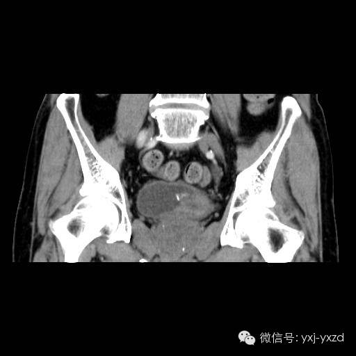 【病例】膀胱癌肉瘤1例CT影像表现 【病例】膀胱癌肉瘤1例CT影像表现