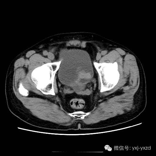 【病例】膀胱癌肉瘤1例CT影像表现 【病例】膀胱癌肉瘤1例CT影像表现