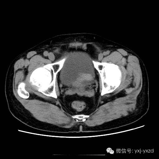 【病例】膀胱癌肉瘤1例CT影像表现 【病例】膀胱癌肉瘤1例CT影像表现