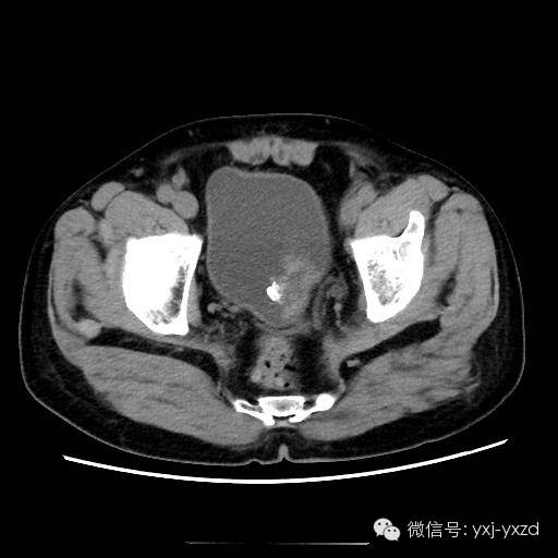 【病例】膀胱癌肉瘤1例CT影像表现 【病例】膀胱癌肉瘤1例CT影像表现