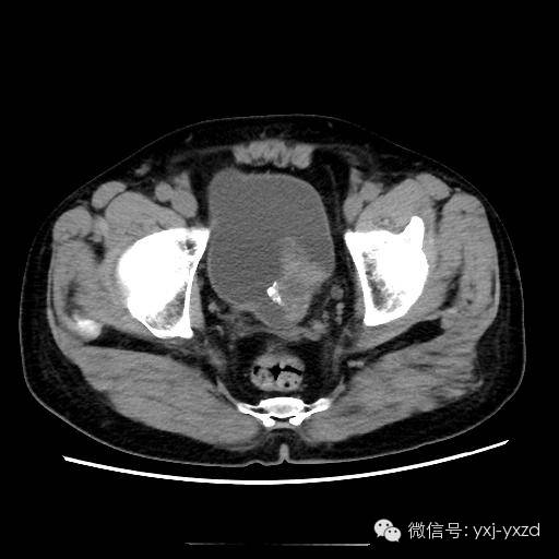 【病例】膀胱癌肉瘤1例CT影像表现 【病例】膀胱癌肉瘤1例CT影像表现