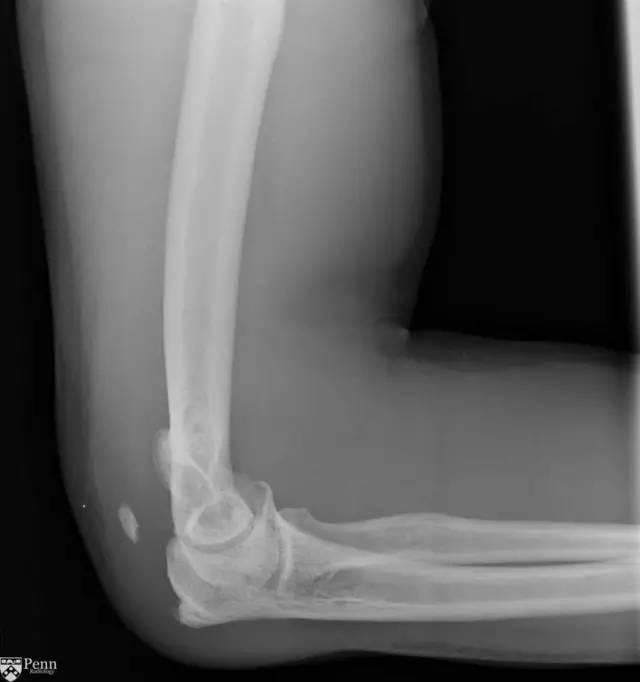 【病例】肱三头肌肌腱撕裂1例MR影像表现 【病例】肱三头肌肌腱撕裂1例MR影像表现