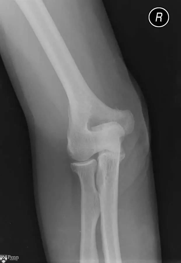 【病例】肱三头肌肌腱撕裂1例MR影像表现 【病例】肱三头肌肌腱撕裂1例MR影像表现