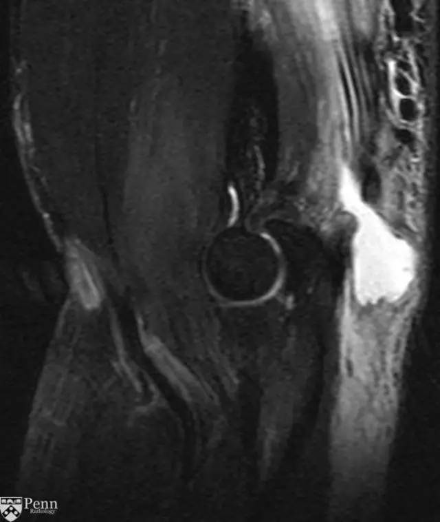 【病例】肱三头肌肌腱撕裂1例MR影像表现
