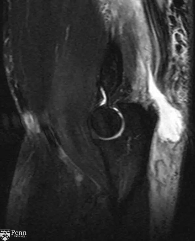 【病例】肱三头肌肌腱撕裂1例MR影像表现 【病例】肱三头肌肌腱撕裂1例MR影像表现