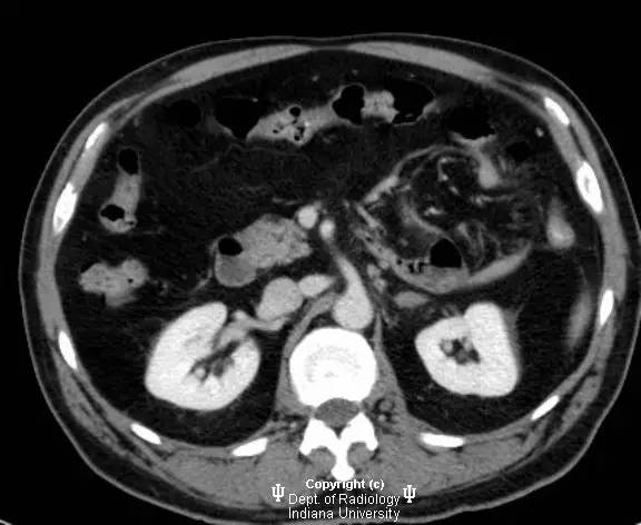 【病例】腹内疝(十二指肠旁疝)1例CT影像表现 【病例】腹内疝(十二指肠旁疝)1例CT影像表现