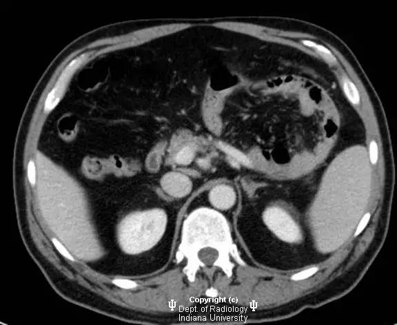 【病例】腹内疝(十二指肠旁疝)1例CT影像表现 【病例】腹内疝(十二指肠旁疝)1例CT影像表现