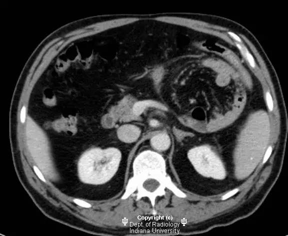 【病例】腹内疝(十二指肠旁疝)1例CT影像表现 【病例】腹内疝(十二指肠旁疝)1例CT影像表现