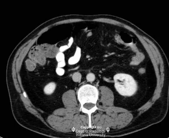 【病例】腹内疝(十二指肠旁疝)1例CT影像表现 【病例】腹内疝(十二指肠旁疝)1例CT影像表现