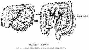 【病例】腹内疝(十二指肠旁疝)1例CT影像表现 【病例】腹内疝(十二指肠旁疝)1例CT影像表现
