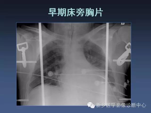 【PPT】多层螺旋CT（MDCT）在胸部外伤诊断中的应用